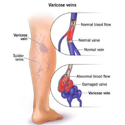 Yasee-Socks-for-Varicose-Veins