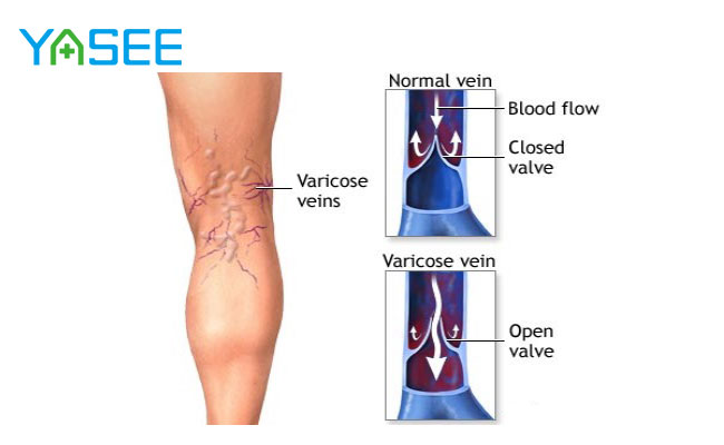 YASEE-Medical-suitable-varicose-vein-stockings